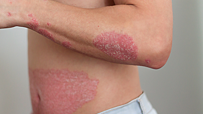 Psoriasis sur le bras et le ventre